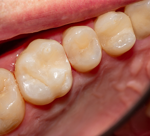 cavity-broken-tooth-3
