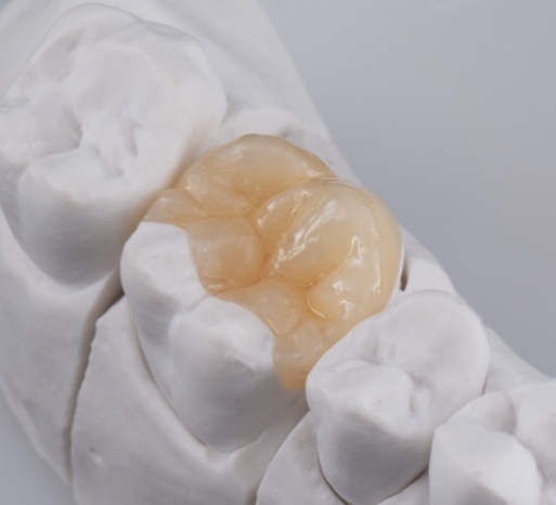 cavity-broken-tooth-4