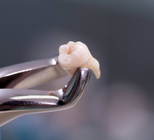 cavity-broken-tooth-5