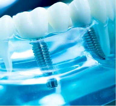 dental-implants-7