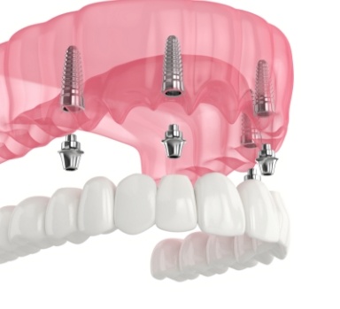 dental-implants-8