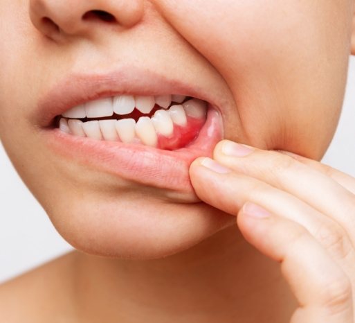 gum-disease-2
