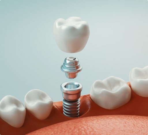 missing-teeth-4