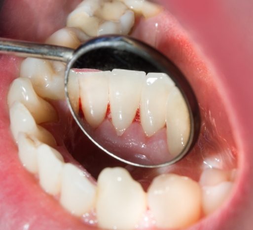 preventive-dentistry-2