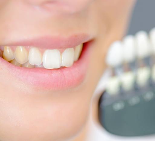 teeth-whitening-3