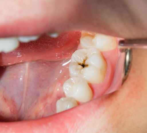 tooth-decay-2